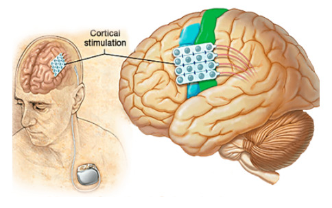 dor, dor cronica, coluna, neurocirurgia