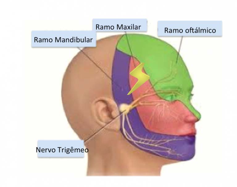 Dor aguda no rosto? Pode ser Neuralgia do Trigêmio - Dra. Fabiana