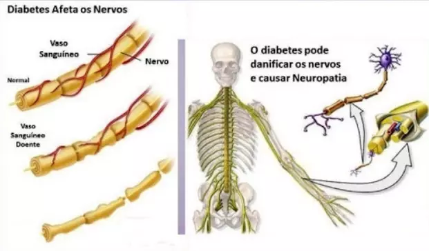 neuropatia diabética