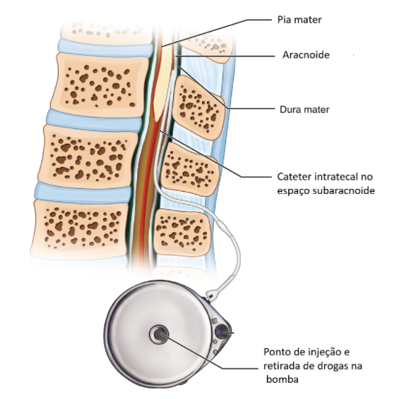 Dor, coluna, neurocirurgia