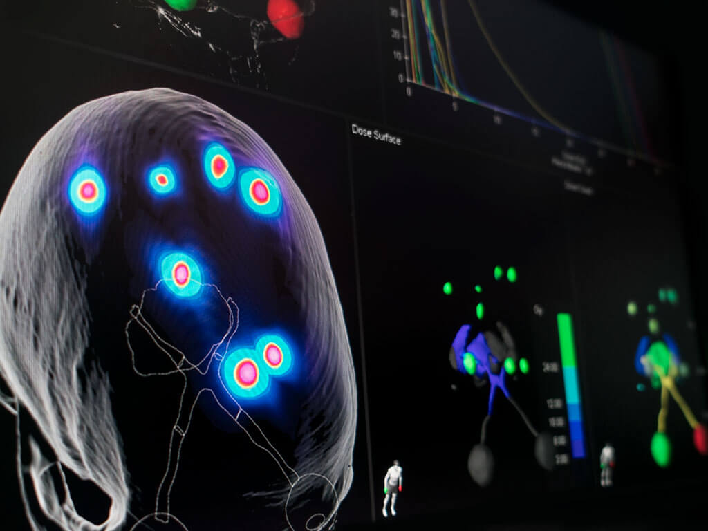 metástases cerebrais