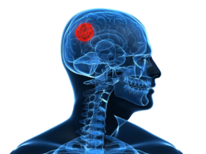 tumor cerebral