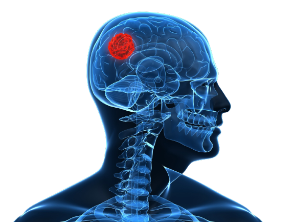tumor cerebral