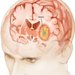 glioma de baixo grau