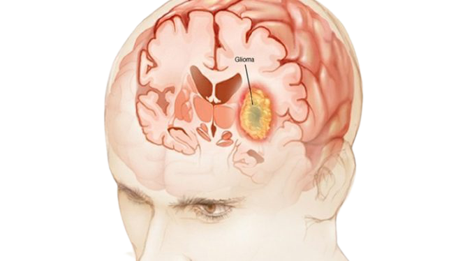 glioma de baixo grau