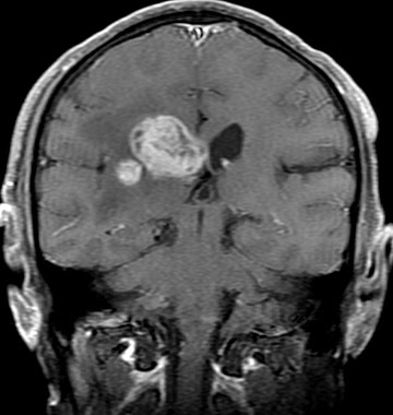 glioma de baixo grau