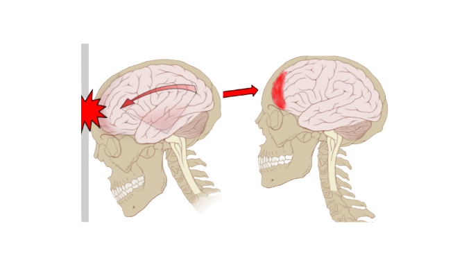 traumatismo cranioencefalico