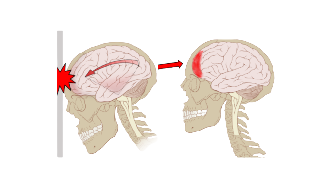 traumatismo cranioencefalico
