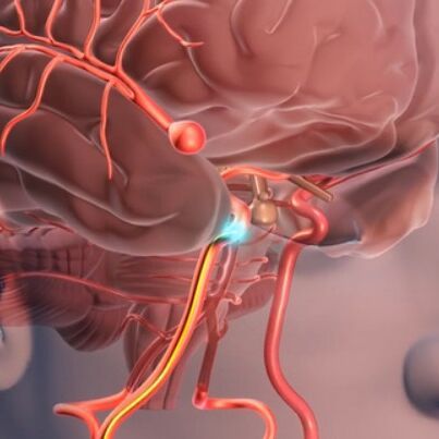 Aneurisma Intracraniano